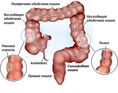 чи можна лікувати тонкий кишечник