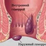 як лікувати аритмію народними засобами