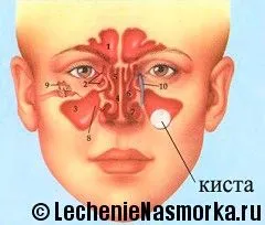 як лікувати кісту в гайморової пазухи