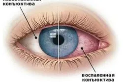 хронічний гайморит заняття спортом