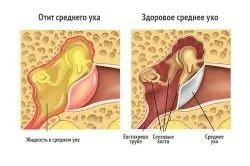 хронічний гайморит заняття спортом