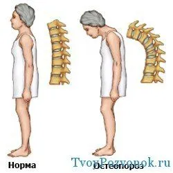 як лікувати остеопороз кісток
