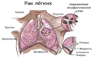 нове в лікуванні раку легенів