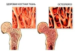 Остеопороз: симптоми і лікування жінки