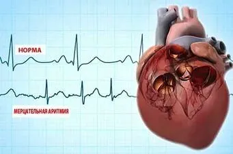 як лікувати аритмію народними засобами