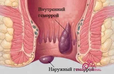як вилікувати геморой реліф