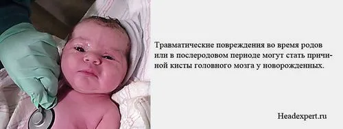 як лікувати кісту головного мозку у новонароджених