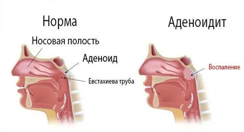 гріємо ніс вареним яйцем
