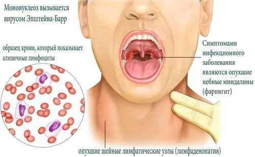 як лікувати лімфовузли при мононуклеозі