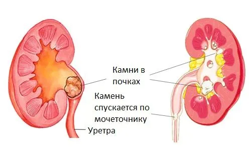 чи можна вилікувати уретрит мирамистином