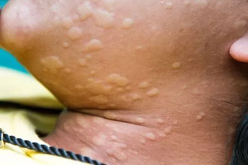 як лікувати кропивницю на обличчі