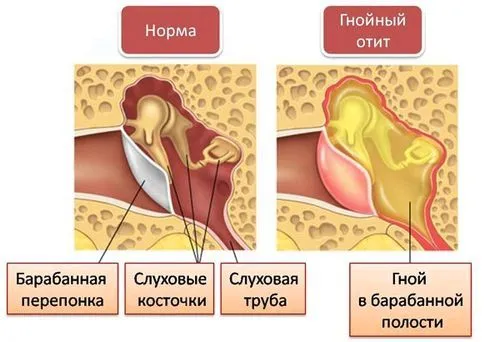 гнійний отит симптоми