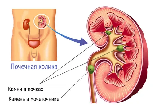 як лікувати нирки від каменів
