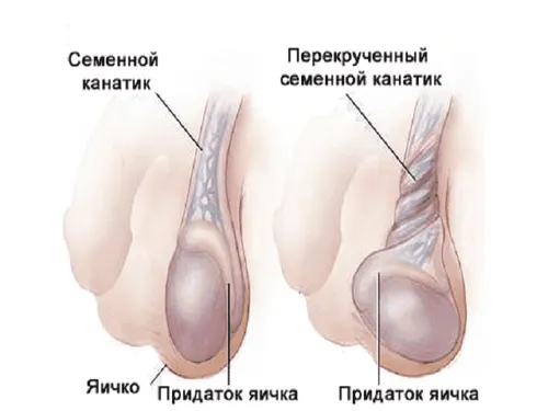 як лікувати кісту придатка яєчка