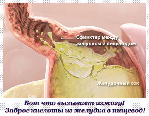 Лікування печії народними засобами як вилікувати шлунок від печії