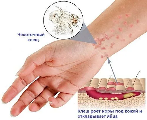 Мазь від корости як лікувати коросту сірчаної маззю