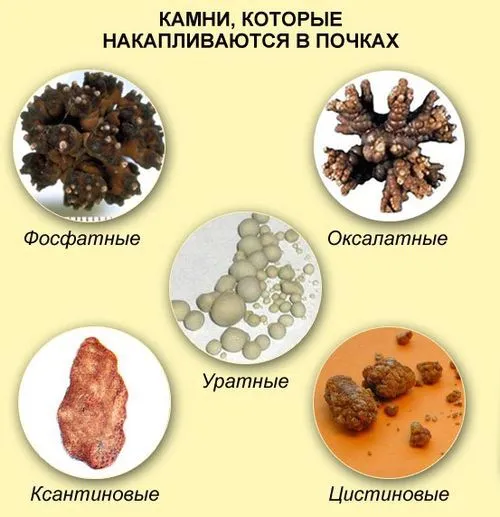 як лікувати нирки від каменів