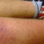 Рожа на нозі: лікування як лікувати пику у дітей