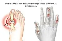 як лікувати артропатіческій псоріаз