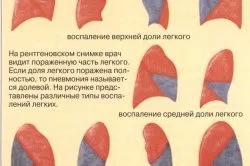 як лікувати пневмонію без температури