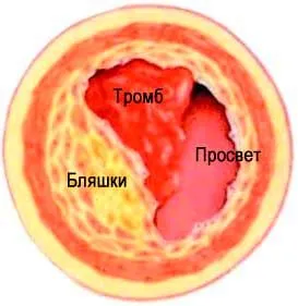 лікувати варикоз при вагітності