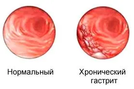 лікувати хронічний гастрит