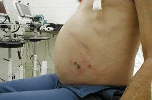 як лікувати цироз печінки 4 стадії