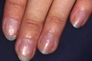 як лікувати нігті в ямочку