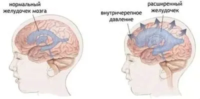 як лікувати розширені судини головного мозку
