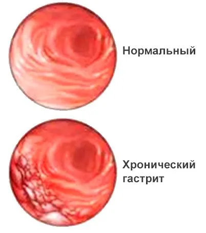 хронічний гастрит атрофічний лікування харчування при загостренні у дітей неатрофіческій симптоми що таке ознаки як вилікувати профілактика класифікація гиперпластический причини ускладнення діагностика патогенез гіперацидний аутоімунний реабілітація при хронічному лимфоидного формуванням клініка активний схема дорослих робити беруть код назавжди гипертрофический МКБ дифузний субатрофический змішаний армія катаральний меню антрум дуоденіт підвищеною кислотністю шлунка типу 10 тобто можна