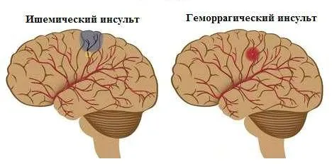 як лікувати розширені судини головного мозку