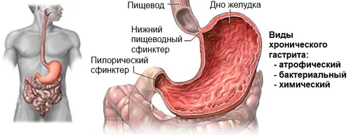 хронічний гастрит атрофічний лікування харчування при загостренні у дітей неатрофіческій симптоми що таке ознаки як вилікувати профілактика класифікація гиперпластический причини ускладнення діагностика патогенез гіперацидний аутоімунний реабілітація при хронічному лимфоидного формуванням клініка активний схема дорослих робити беруть код назавжди гипертрофический МКБ дифузний субатрофический змішаний армія катаральний меню антрум дуоденіт підвищеною кислотністю шлунка типу 10 тобто можна