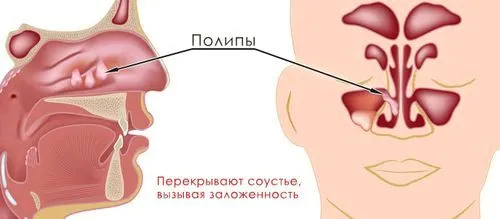 Поліпозно синусит: симптоми і лікування захворювання як лікувати поліпозний синусит