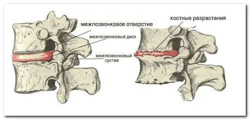 як лікувати хондроз шийного відділу