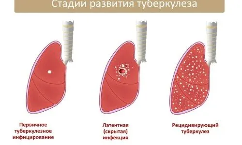 як лікувати туберкульоз на ранній стадії