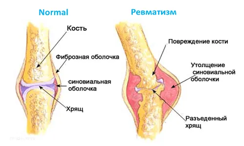 як лікувати ревматизм ніг у дітей