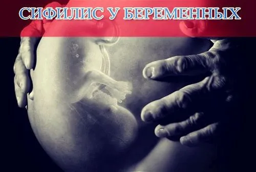 як лікувати сифіліс у вагітних