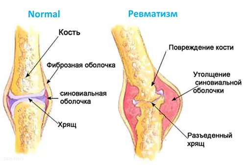 як лікувати ревматизм ніг