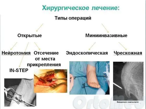 як лікувати розрив фасції