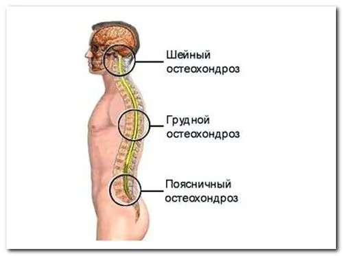 як лікувати хондроз шийного відділу