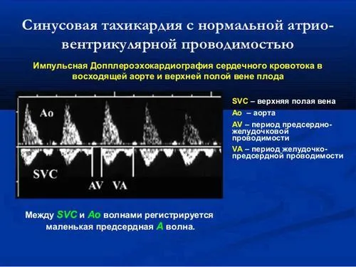 як лікувати тахікардію плода