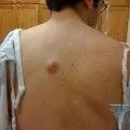 як лікувати жировик на губі