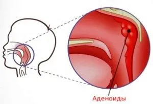 як лікувати у дитини закладеність носа