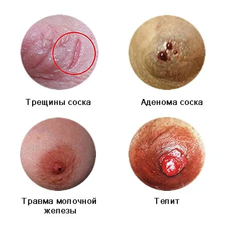 Кров'янисті виділення (перед місячними) перед місячними