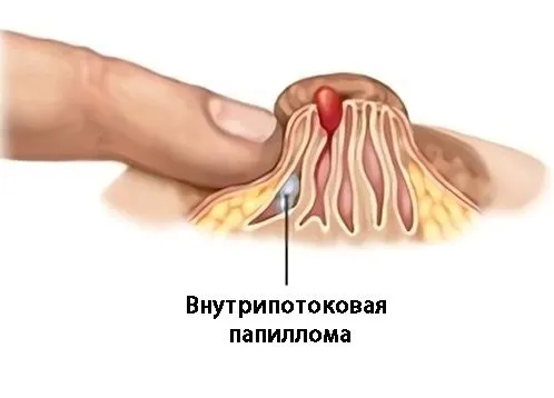 Кров'янисті виділення (перед місячними) місячних