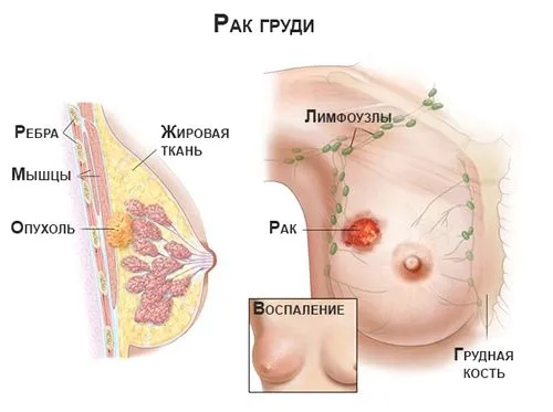 Кров'янисті виділення (місячних) місячних може