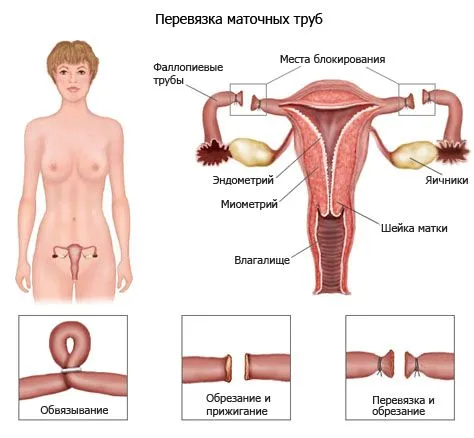 Перев'язані труби затримка місячних (місячних) може бути затримка місячних 10 днів