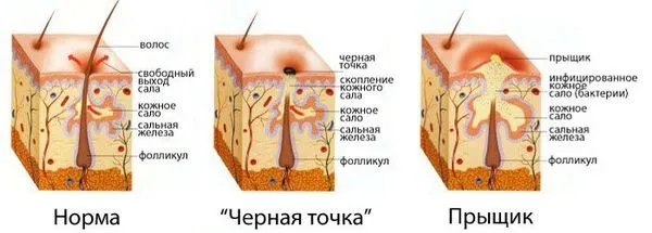 Прищі перед місячними: причини та способи лікування (жіночий організм) перед місячними