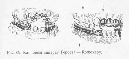 Хербст апарат на неговата част, монтаж и експлоатация