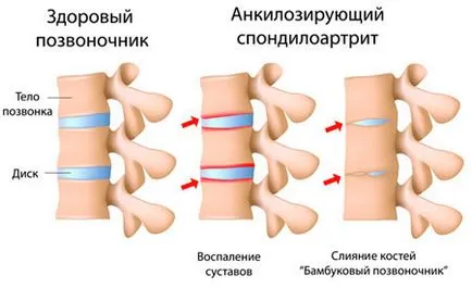 Анкилозиращ спондилит и други серонегативни заболяване